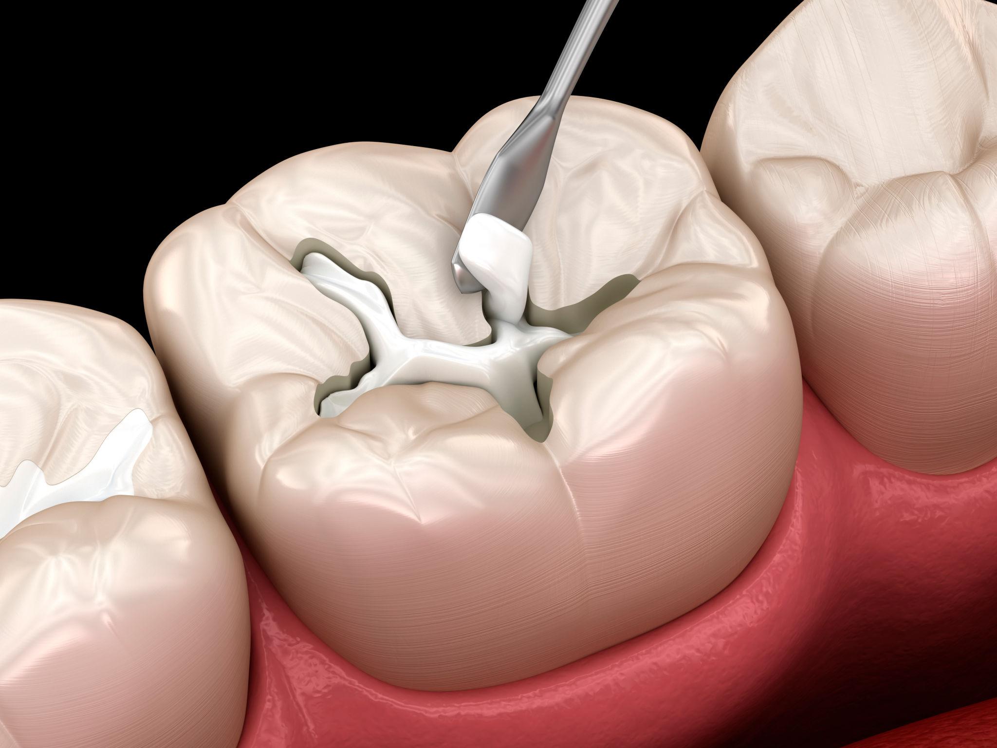 Filling Restorative